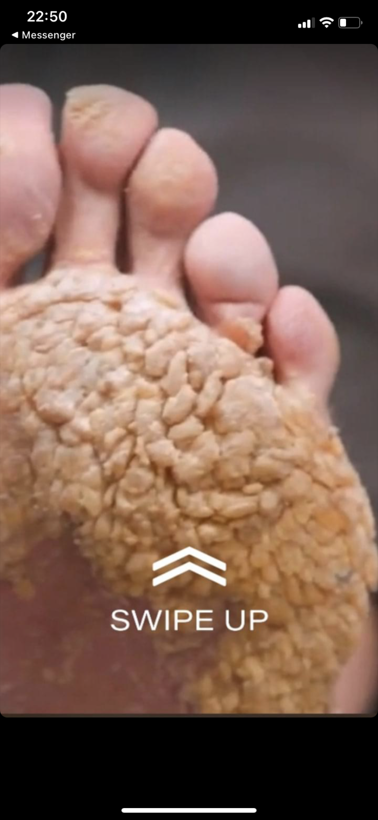 The Dangers of Ignoring Toenail Fungal Infections News 25 Story